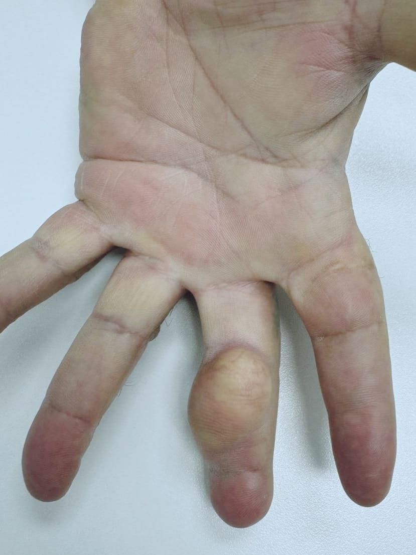 Плотнику удалили 25-летнюю опухоль на пальце