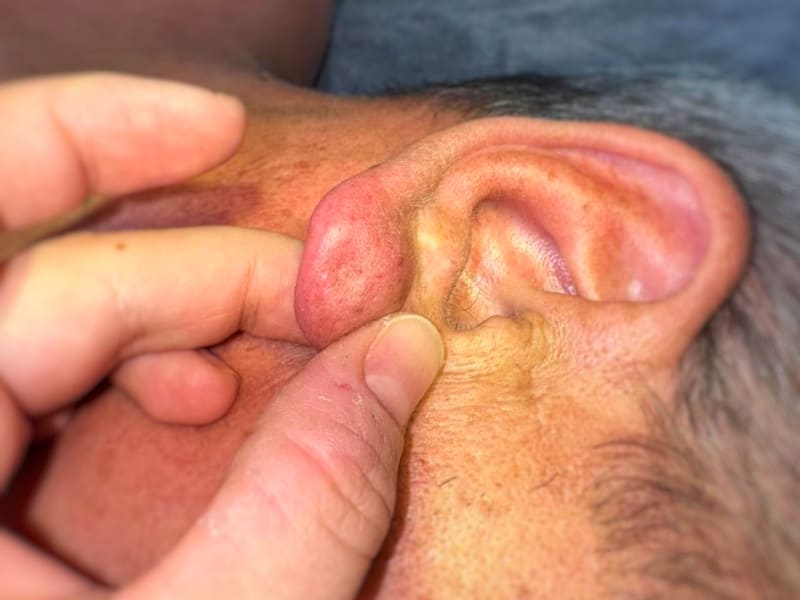 Шишки вместо серёжек: житель Апрелевки жил с атеромами на ушах. Как ему помогли хирурги?