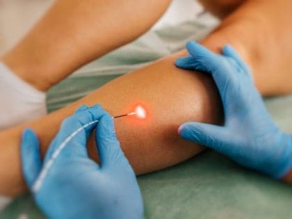 Лечение варикоза лазером в Апрелевке: новое оборудование