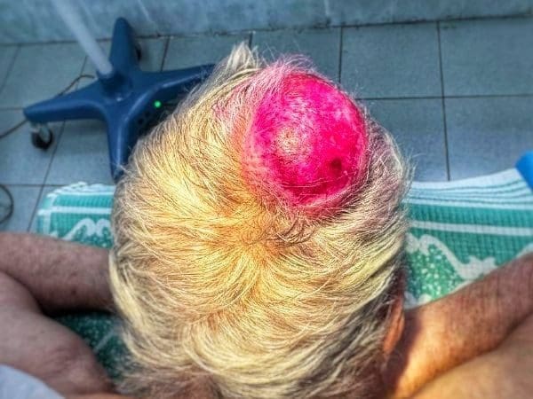 Удаление атеромы в 90 лет — история из Наро-Фоминска