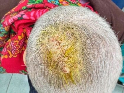 Удаление атеромы в 90 лет — история из Наро-Фоминска