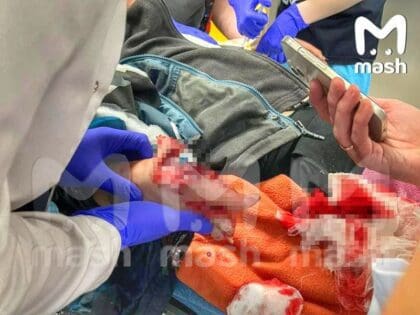 В Красногорске ребенок пострадал от взрыва денежной купюры